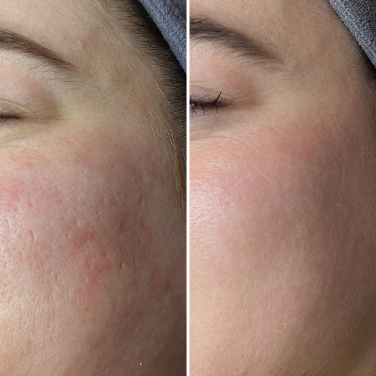 microneedling
