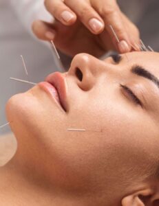 akupunktur kecantikan