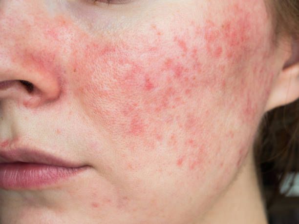 Skin Barrier Melemah, Kulit Pun Kehilangan Pertahanannya